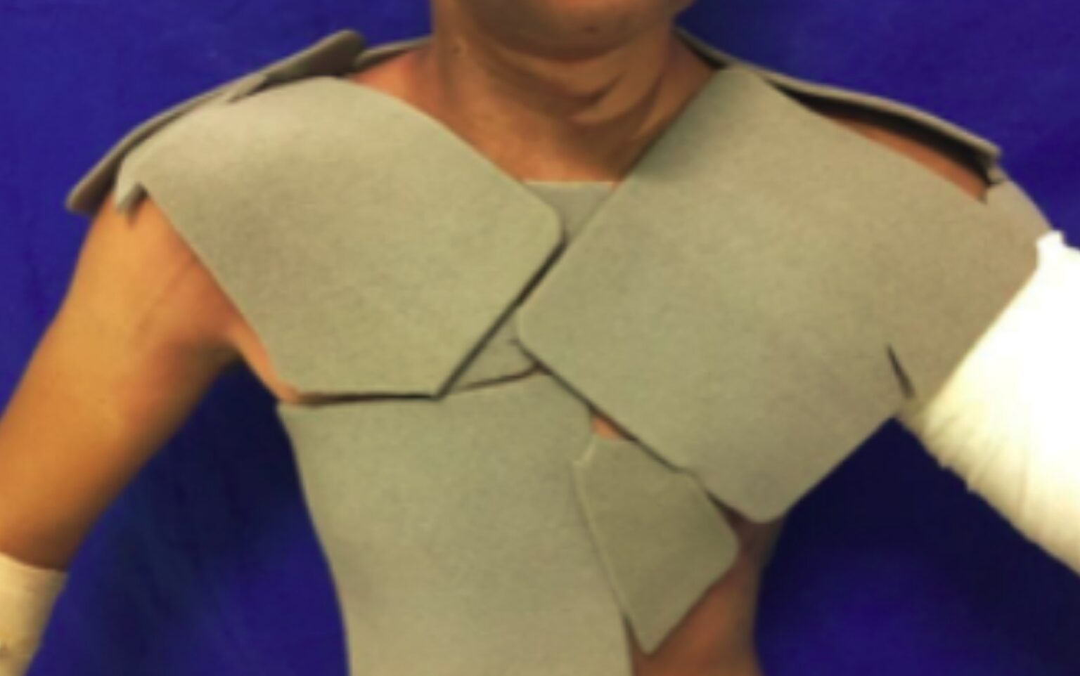 Curativo Moderno Pode Tornar Tratamento de Queimaduras Mais Eficiente e Econômico Curativo Moderno Pode Tornar Tratamento de Queimaduras Mais Eficiente e Econômico