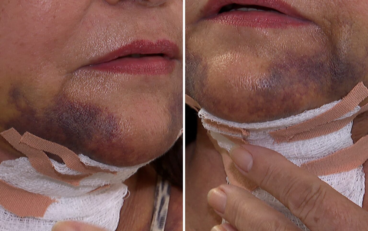 Laudo Revela Deformidade Permanente em Paciente Após Procedimento Estético em Ribeirão Preto