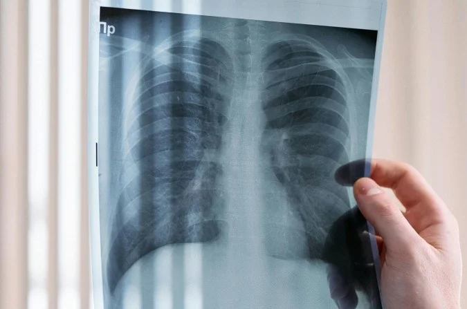 Obesidade e Inflamação: Principais Fatores que Aceleram o Envelhecimento Pulmonar Obesidade e Inflamação: Principais Fatores que Aceleram o Envelhecimento Pulmonar