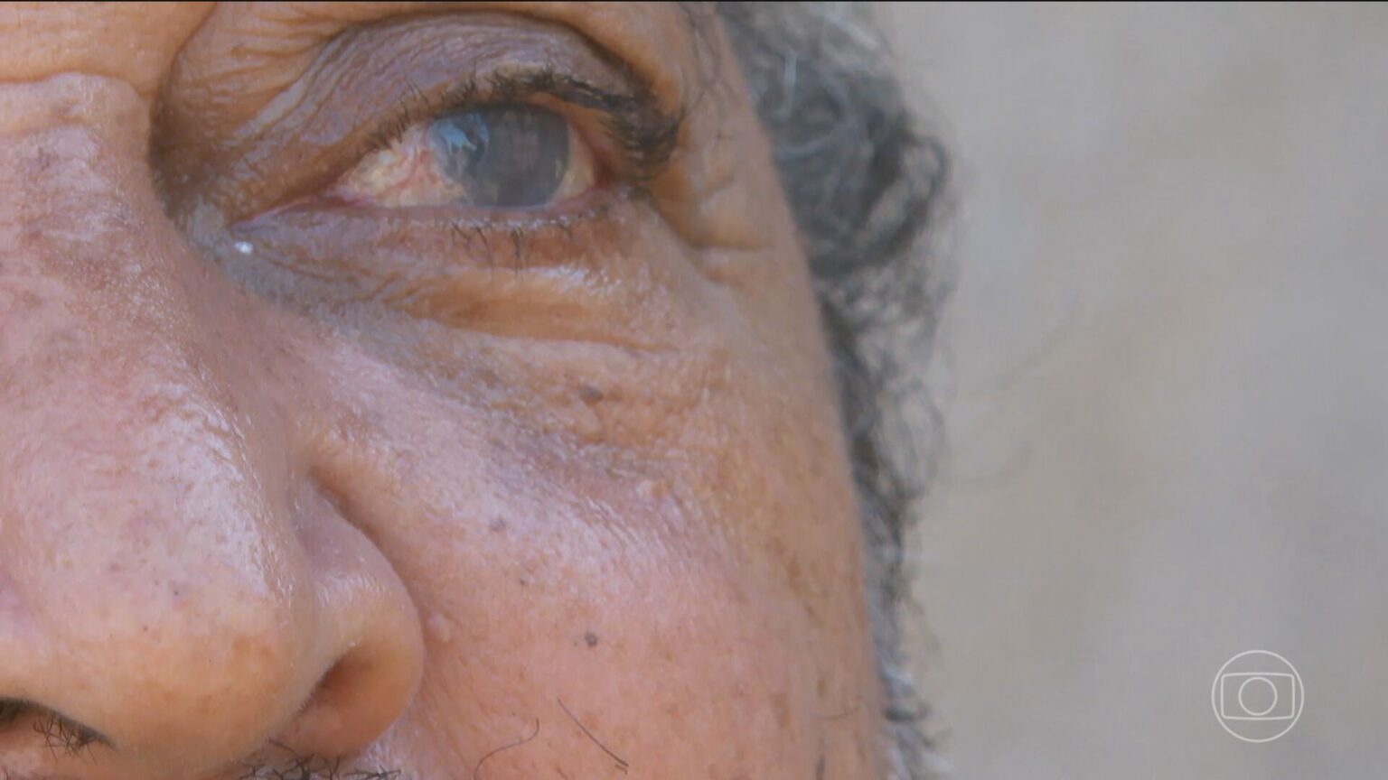 Pacientes Lesados em Mutirão de Cirurgias de Catarata: Um Ano Após Denúncias em SP Pacientes Lesados em Mutirão de Cirurgias de Catarata: Um Ano Após Denúncias em SP