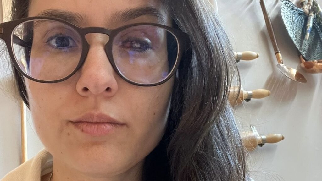 Terapeuta Enfrenta Transplante de Córnea Após Contaminação por Ameba em Lentes de Contato