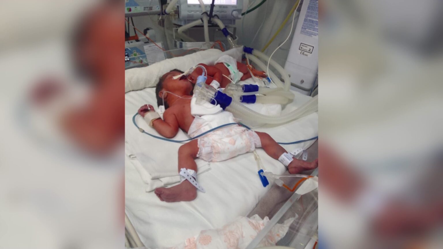 Gêmeas Unidades pela Cabeça: Atualização sobre Separação em Ribeirão Preto