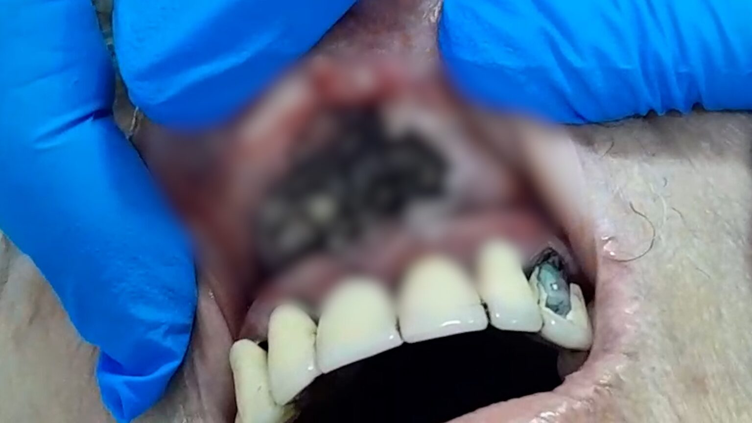 Idosa em Casa de Repouso Ilegal Apresenta Infecção Grave com Larvas na Gengiva