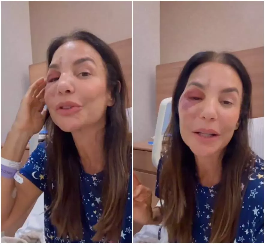 Ivete Sangalo Detalha Recuperação Após Cirurgia Facial: ‘Poderia ter sido Muito Pior’ Ivete Sangalo Detalha Recuperação Após Cirurgia Facial: 'Poderia ter sido Muito Pior'