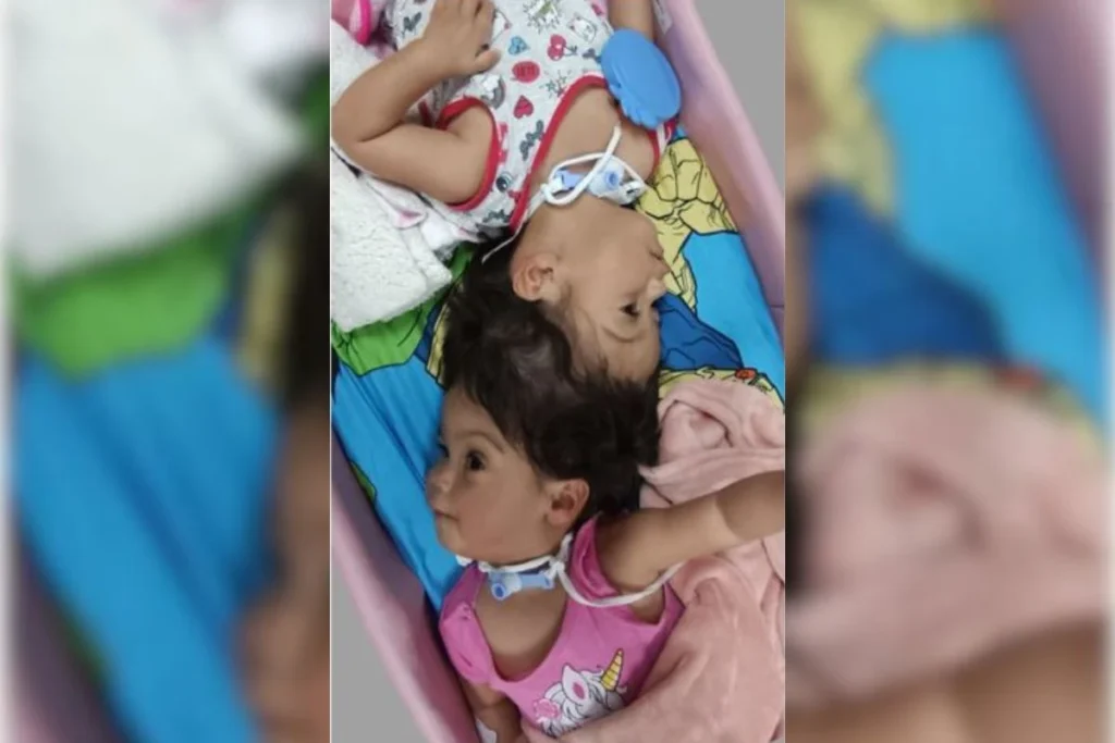 Quarta Cirurgia de Gêmeas Siamesas Encaminha Para Separação Completa
