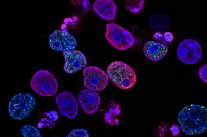 Novo Tratamento com Células CAR-T para Leucemia Pode Chegar ao SUS em Dois Anos Novo Tratamento com Células CAR-T para Leucemia Pode Chegar ao SUS em Dois Anos