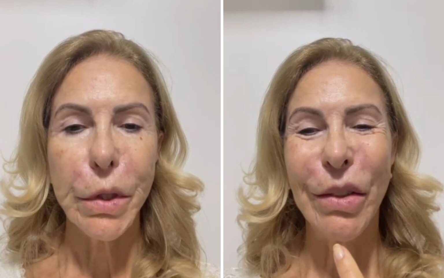 Psicóloga Denuncia Dentista por Sequelas Estéticas: 'Meu Lábio Superior Não Movimenta'